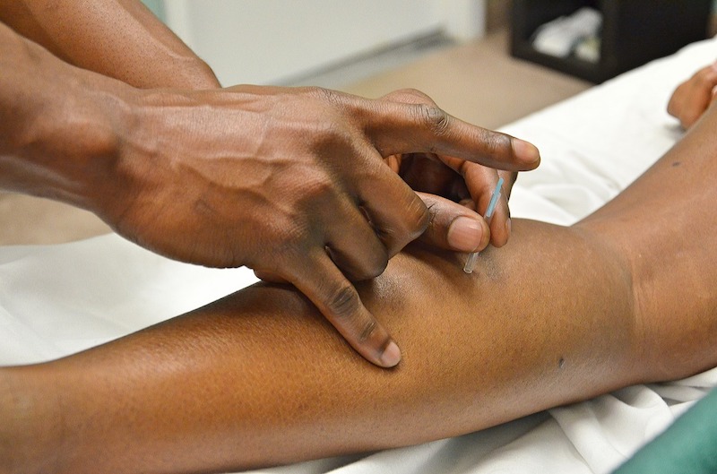 Functional Dry Needling Gaining Popularity