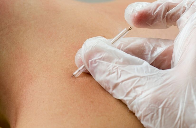Dry Needling Explained